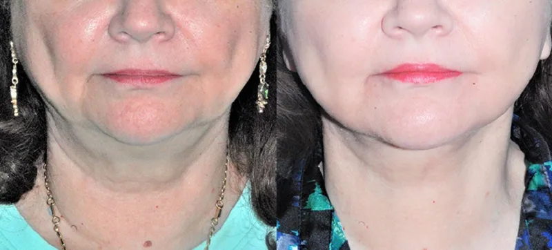 Hình ảnh sau khi căng da vùng cổ cho khách hàng có dấu hiệu chùng, chảy xệ nhiều, rãnh nếp nhăn hằn sâu