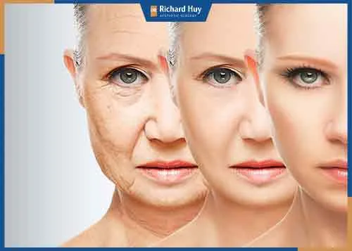 Căng da mặt là phương pháp thẩm mỹ hiện đại giúp trẻ hóa làn da
