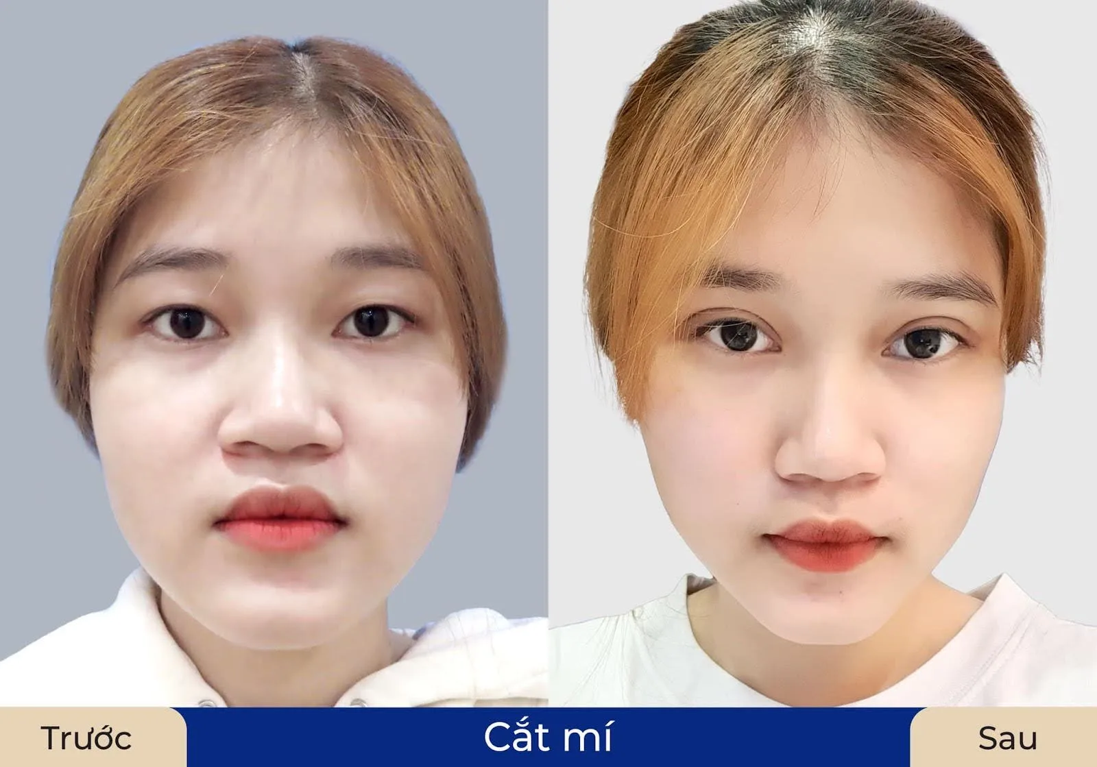 Cắt mí Plasma sử dụng dao mổ giúp hạn chế tối đa xâm lấn và chảy máu