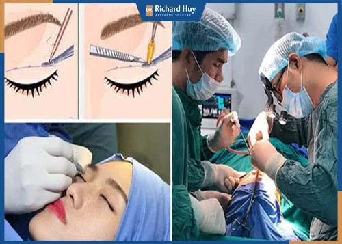 Bác sĩ tiến hành phẫu thuật và xác định tỷ lệ vùng mắt Bác sĩ tiến hành phẫu thuật và xác định tỷ lệ vùng mắt