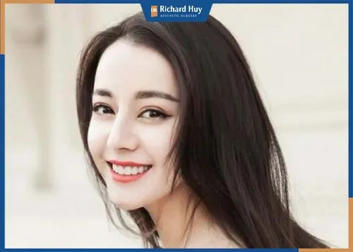 Gương mặt trẻ trung, đầy sức sống sau khi cấy mỡ mặt 