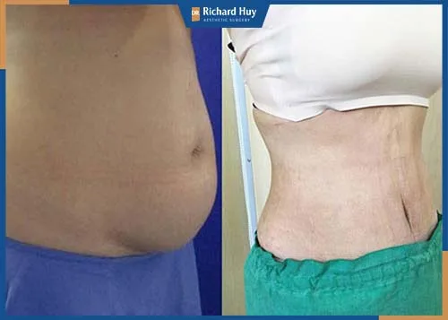 Vùng bụng sau khi giảm tạo vòng eo 56 gọn gàng quyến rũ 