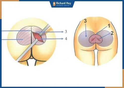 Mô phỏng kĩ thuật nâng mông bằng túi độn Mô phỏng kĩ thuật nâng mông bằng túi độn