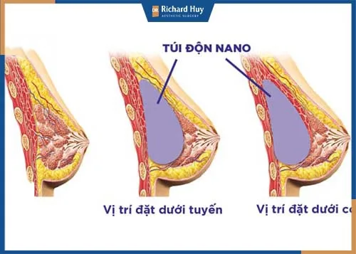 Mô phỏng kỹ thuật nâng ngực bằng túi Nano chíp thông minh