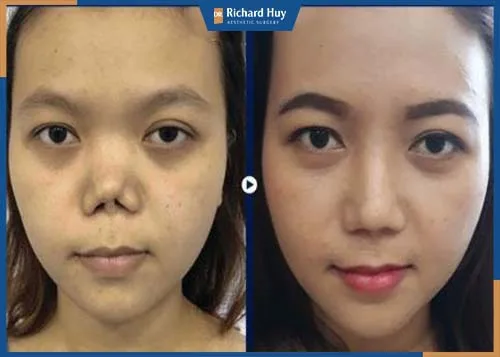 Mũi cao thẳng tự nhiên hài hòa với gương mặt sau phẫu thuật 