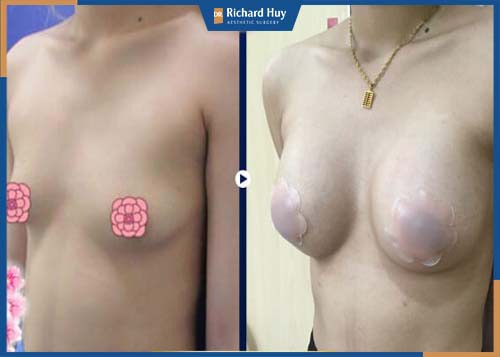 Hình ảnh khách hàng nâng ngực bằng mỡ tự thân 
