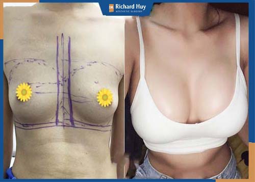 Hình ảnh khách hàng phẫu thuật ngực bằng nano chip 