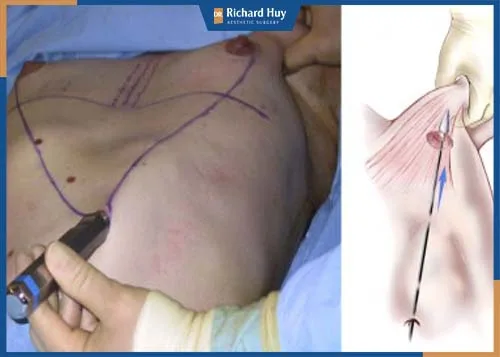 Nâng ngực qua đường rốn ít được ưa chuộng do kỹ thuật phức tạp