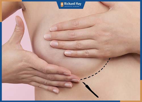 Nâng ngực qua nếp gấp chân ngực khó phát hiện sẹo 