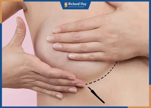 Nâng ngực qua nếp gấp chân ngực khó phát hiện sẹo 