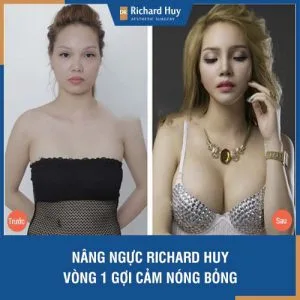 Nâng ngực Dr Richard Huy - Vòng 1 gợi cảm, nóng bỏng