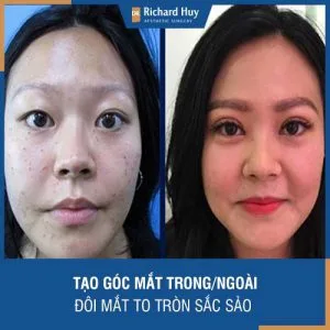 Tạo góc mắt trong/ngoài - Giải pháp đôi mắt to tròn, sắc sảo