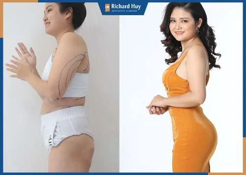 Hình ảnh khách hàng tăng 7 cm vòng mông sau phẫu thuật Hình ảnh khách hàng tăng 7 cm vòng mông sau phẫu thuật