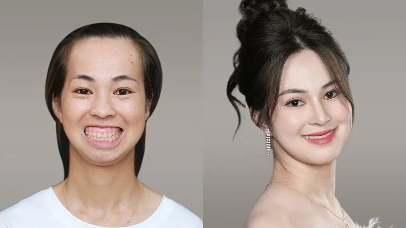 Khách hàng thực hiện dịch vụ chỉnh hô 2 hàm kết hợp trượt cằm tại Dr. Richard Huy