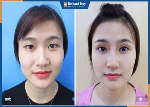 Độn thái dương có ảnh hưởng đến mắt không?