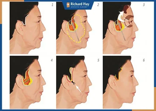 Nên độn thái dương ở cơ sở thẩm mỹ nào?