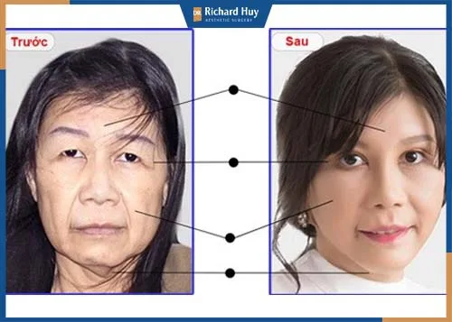 Căng da mặt can thiệp và tác động vào vùng da mặt giải quyết triệt để phần da chùng, da chảy xệ do lão hóa. Căng da mặt can thiệp và tác động vào vùng da mặt giải quyết triệt để phần da chùng, da chảy xệ do lão hóa.