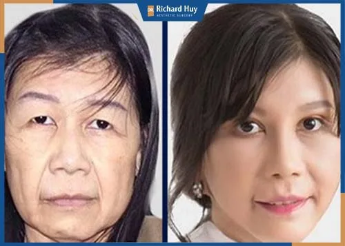 Kéo căng da mặt kéo lại tuổi thanh xuân Kéo căng da mặt kéo lại tuổi thanh xuân