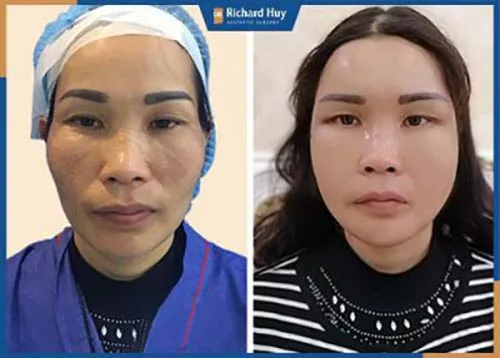 Dịch vụ làm căng bóng da mặt Dịch vụ làm căng bóng da mặt