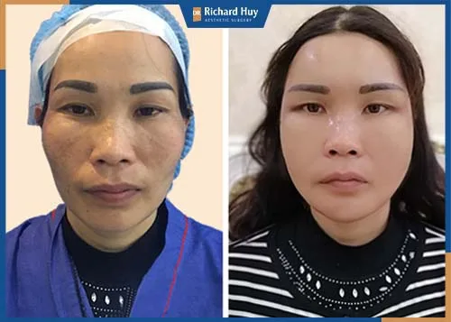 Phương pháp sử dụng mỡ tự thân của cơ thể làm đầy gương mặt Phương pháp sử dụng mỡ tự thân của cơ thể làm đầy gương mặt