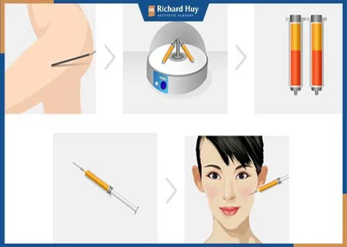 Mô phỏng kỹ thuật cấy mỡ Nano Fat