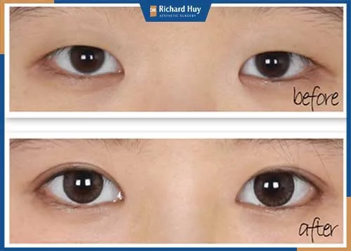 Có nên nhấn mí bằng chỉ hay không? Có nên nhấn mí bằng chỉ hay không?