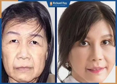 Căng da mặt có ảnh hưởng gì không? Căng da mặt có ảnh hưởng gì không?