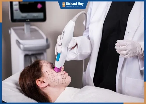 Công nghệ Thermage FLX là biện pháp xóa nếp nhăn trán hiệu quả nhất hiện nay