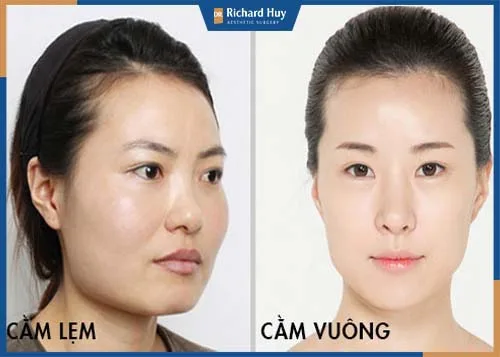 Một số đối tượng nên thực hiện gọt cằm Vline cho gương mặt thon gọn Một số đối tượng nên thực hiện gọt cằm Vline cho gương mặt thon gọn