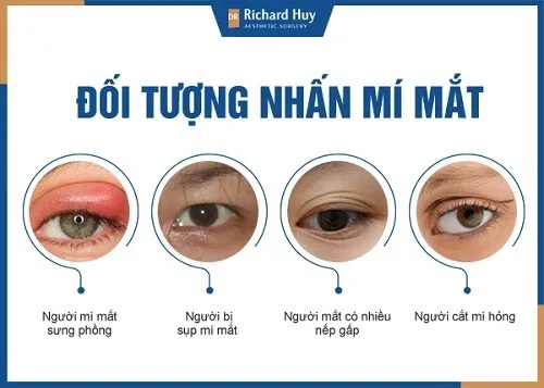 Những trường hợp phù hợp nhấn mí mắt Những trường hợp phù hợp nhấn mí mắt
