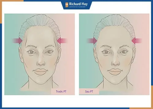 Huyệt thái dương lõm phải làm sao?