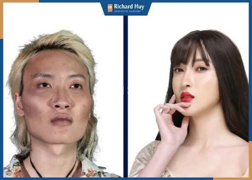Giải quyết triệt để tình trạng mặt vuông, hàm bạnh sau phẫu thuật 