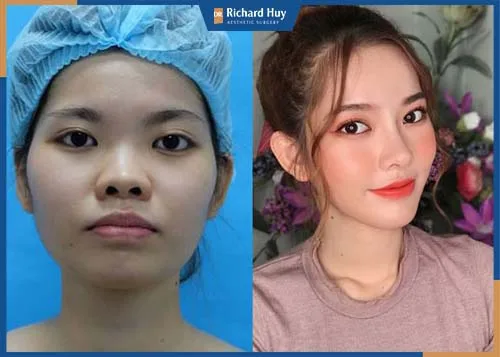 Hình ảnh khách hàng sau 1 tháng phẫu thuật gọt cằm Hình ảnh khách hàng sau 1 tháng phẫu thuật gọt cằm