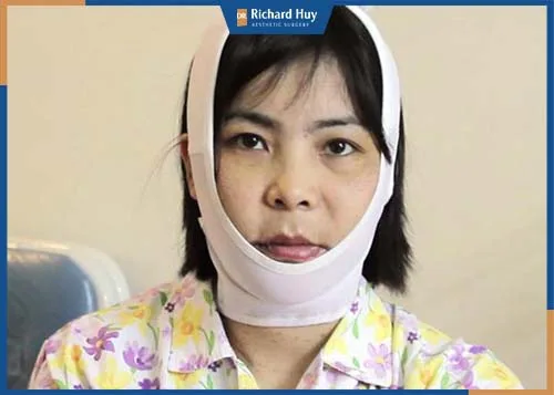 Khách hàng cố định cằm và giảm sưng sau 5 ngày phẫu thuật Khách hàng cố định cằm và giảm sưng sau 5 ngày phẫu thuật