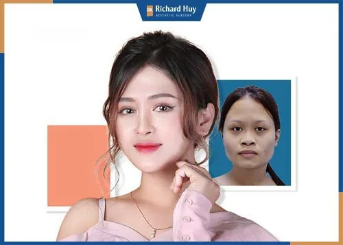 Gọt cằm là phương pháp can thiệp và điều chỉnh cấu trúc xương cằm giúp gương mặt hài hòa, cân đối Gọt cằm là phương pháp can thiệp và điều chỉnh cấu trúc xương cằm giúp gương mặt hài hòa, cân đối