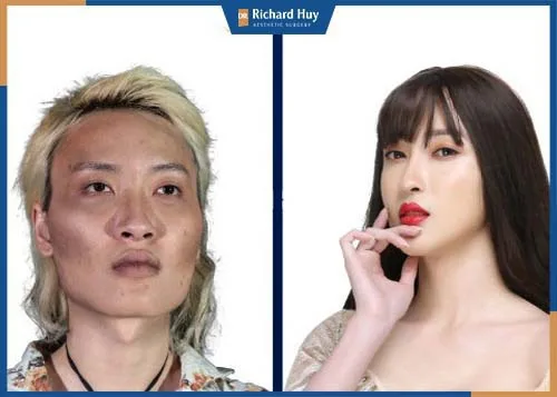 Khách hàng sau phẫu thuật gương mặt Vline thanh thoát, thoát tình trạng mặt vuông thô cứng 