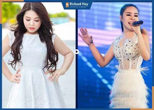 Hình ảnh khách hàng sau 1 tháng hút mỡ, hồi phục hoàn toàn 