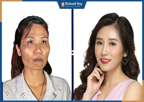 Làm sao để thái dương đầy nhanh chóng, an toàn?