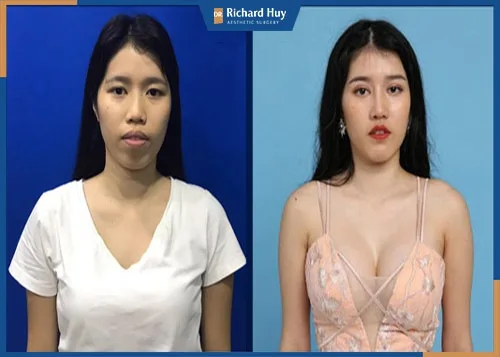 Khách hàng trải nghiệm đặt túi độn Nano Chip