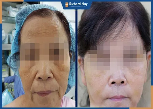 Dr.Richard Huy ứng dụng công nghệ nâng cơ mặt mới nhất