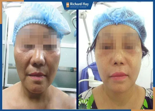 Hình ảnh khách hàng sau khi nâng cơ mặt