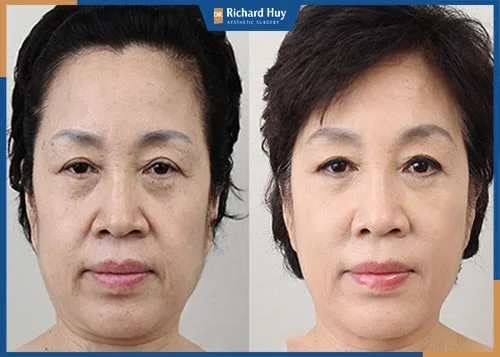 Có nên thẩm mỹ trẻ hóa làn da hay không? Có nên thẩm mỹ trẻ hóa làn da hay không?