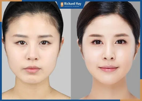 Cằm ngắn sau khi được khắc phục gương mặt được sáng, tỷ lệ gương mặt cân đối hài hòa Cằm ngắn sau khi được khắc phục gương mặt được sáng, tỷ lệ gương mặt cân đối hài hòa
