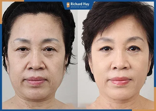 Căng da nội soi phù hợp với những người có tình trạng lão hóa nặng từ 40 tuổi trở đi Căng da nội soi phù hợp với những người có tình trạng lão hóa nặng từ 40 tuổi trở đi