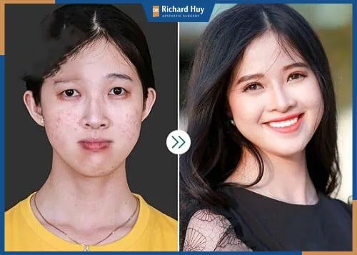 Gương mặt có cằm ngắn mất tự tin, kém duyên. Gương mặt được thay đổi, nổi bật hơn sau khi khắc phục cằm ngắn Gương mặt có cằm ngắn mất tự tin, kém duyên. Gương mặt được thay đổi, nổi bật hơn sau khi khắc phục cằm ngắn