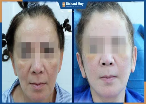 Trẻ hóa làn da giờ đây đã không còn khó khăn như trước