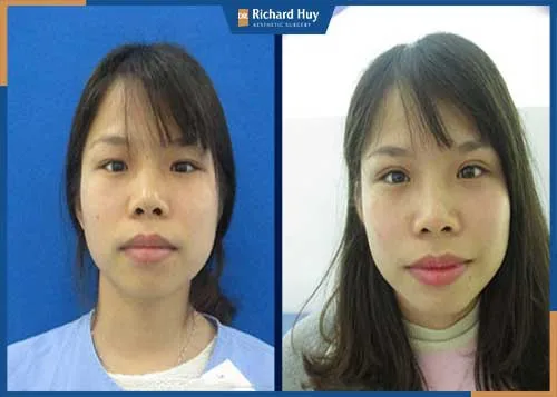 Nhấn mí bằng kỹ thuật Dove Eyes Nhấn mí bằng kỹ thuật Dove Eyes