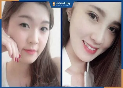 Kết quả của khách hàng khi nhấn mí bằng chỉ Kết quả của khách hàng khi nhấn mí bằng chỉ