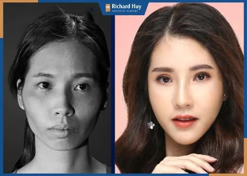 Cằm ngắn làm gương mặt già nua, mất sự cân đối trên gương mặt Cằm ngắn làm gương mặt già nua, mất sự cân đối trên gương mặt