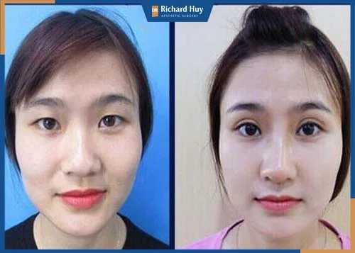 Thông thường một đôi mắt nhấn mí đẹp nhất trong khoảng thời gian từ 2 đến 3 năm. Thông thường một đôi mắt nhấn mí đẹp nhất trong khoảng thời gian từ 2 đến 3 năm.